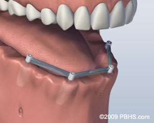 South Bend Oral Surgery, Implant Overdenture