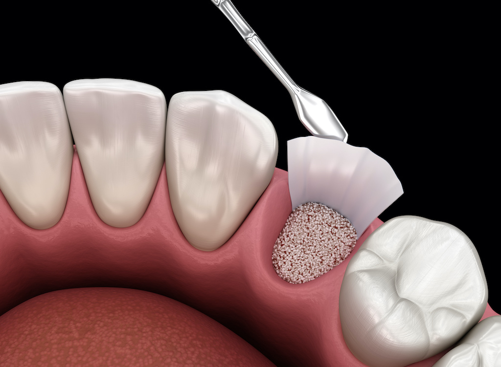 an example of what a bone graft looks like for teeth after a tooth is removed through a tooth extraction