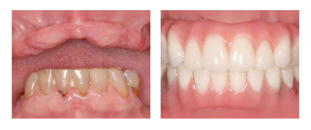 A patient's before and after photo of their dentures