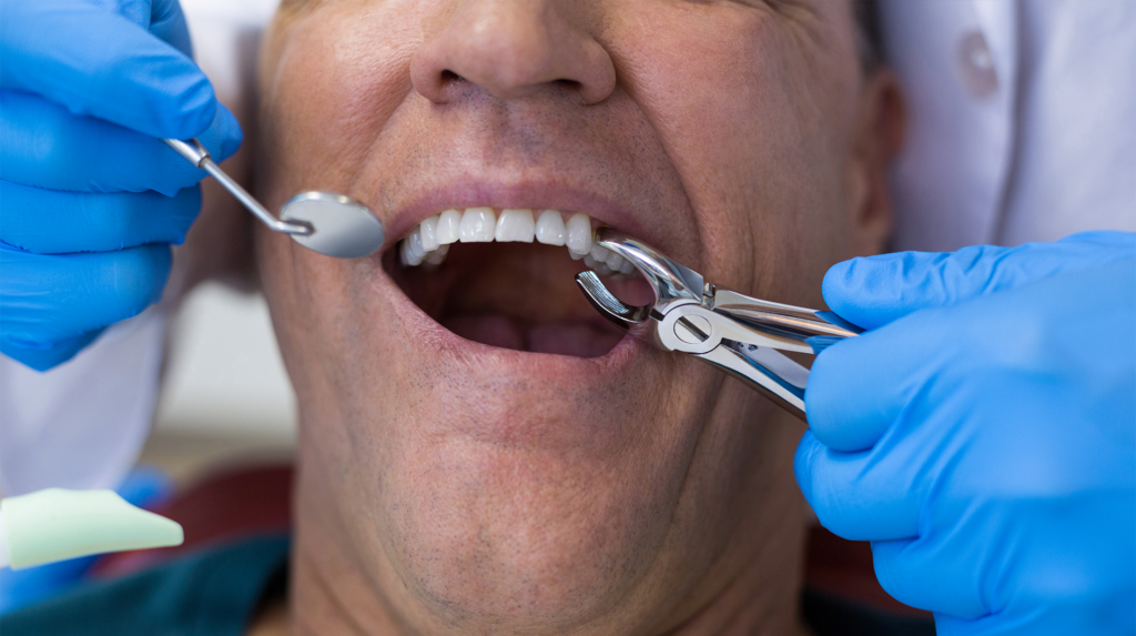 man getting a tooth removed in an oral surgery